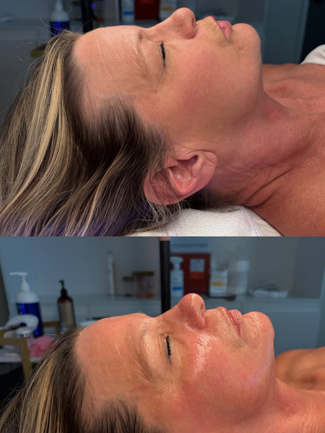 Facial Treatment — Before & After