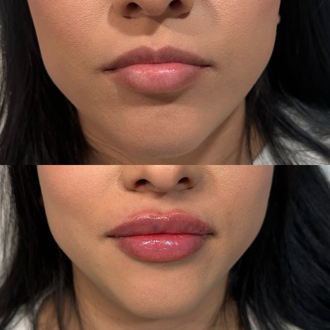 Lip Filler — Before & After