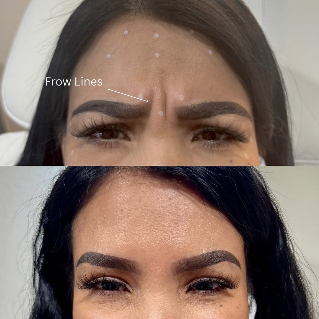 Botox — Frow Lines Before & After