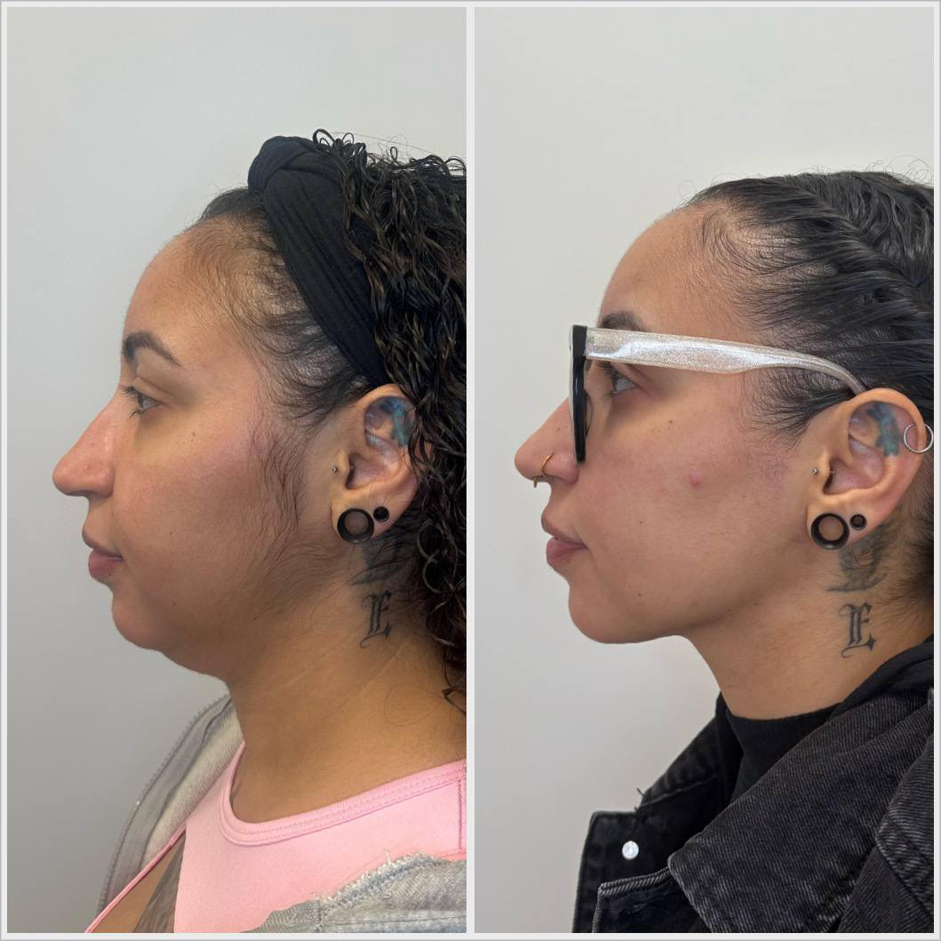 Double Chin Removal — Featured Result